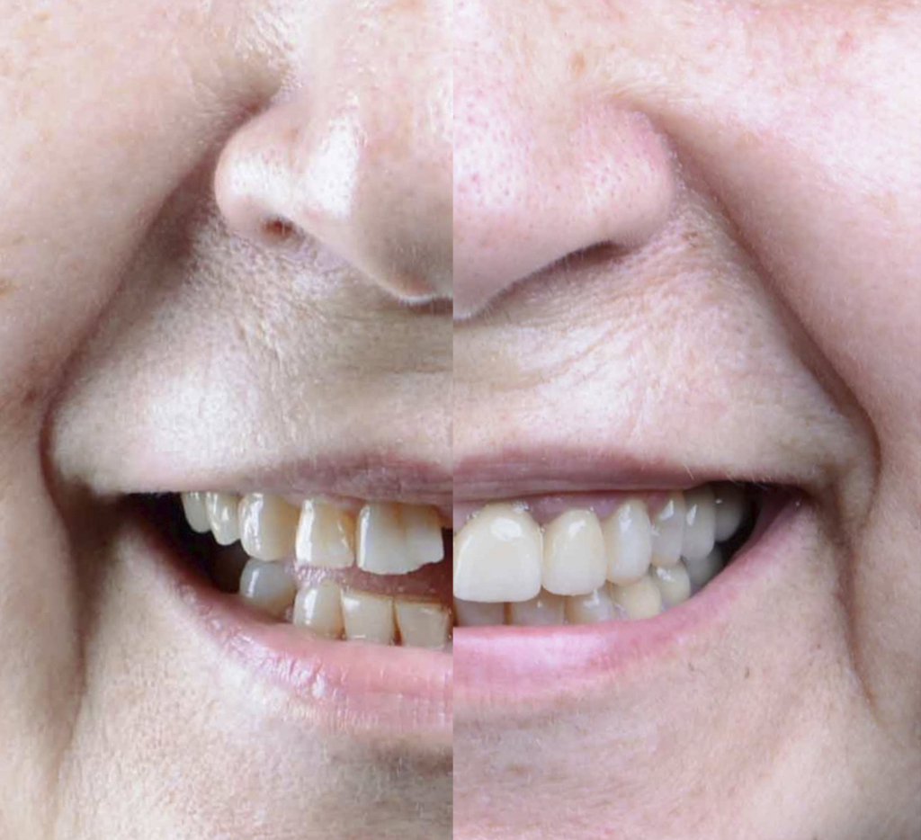 Rehabilitación completa con coronas de zirconio
